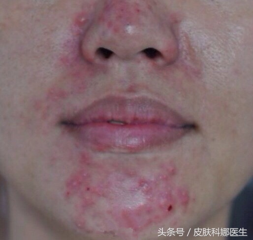 本以为脸部皮肤易发红是因为敏感，到医院检查后，却被诊为这种病