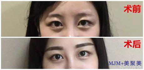 刚做完眉毛怎么那么黑,刚做完的眉毛很黑很浓怎么办