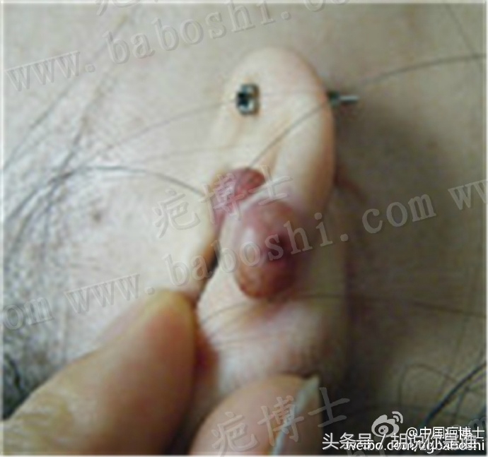 疤痕贴为什么价格悬殊这么大,疤痕一般什么价格