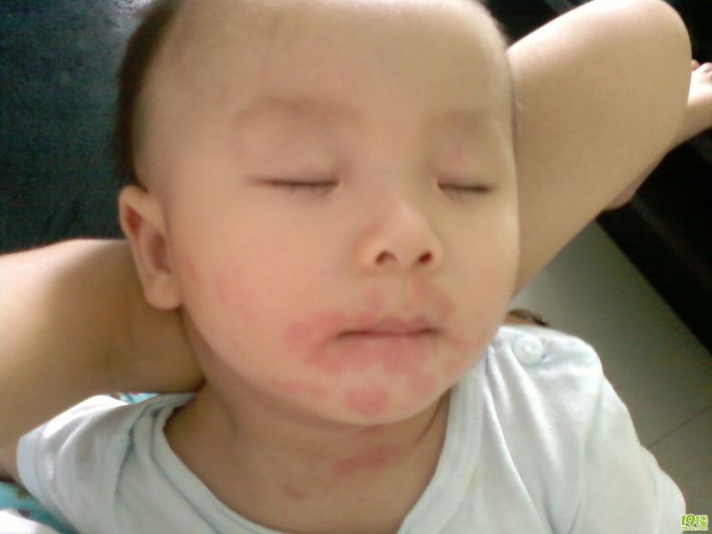 孩子食物过敏需要吃药吗,孩子食物过敏要不要去幼儿园