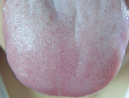 什么是舌苔薄白多津,什么是舌苔厚