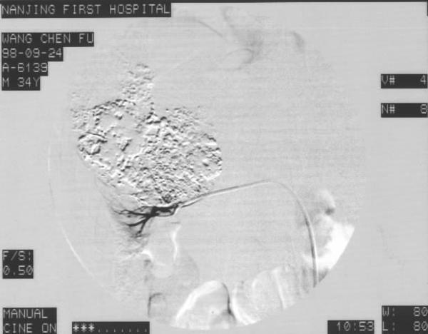 肾恶性肿瘤切除后能活多久,肾恶性肿瘤手术费用