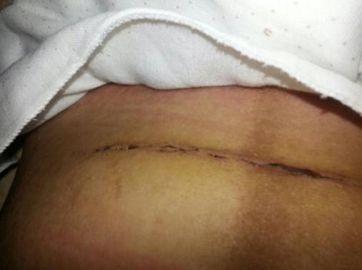 剖腹产的痛只有剖腹产的人才知道,你以为的剖腹产实际的剖腹产