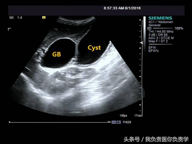楂樻墜杩涢樁鑵拌吂璁粌,鑳嗗泭缁撶煶绌垮瓟鐥囩姸