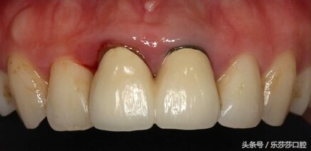 做了烤瓷牙真的会害人一辈子吗,做烤瓷牙的人都后悔吗