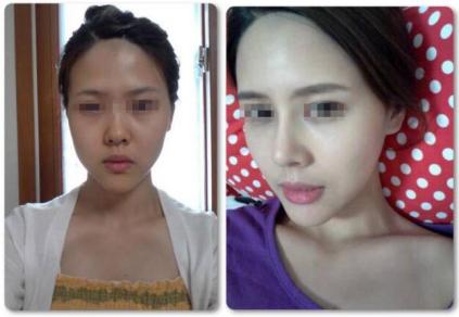 痱子粉也能隆鼻啊？看完给跪了