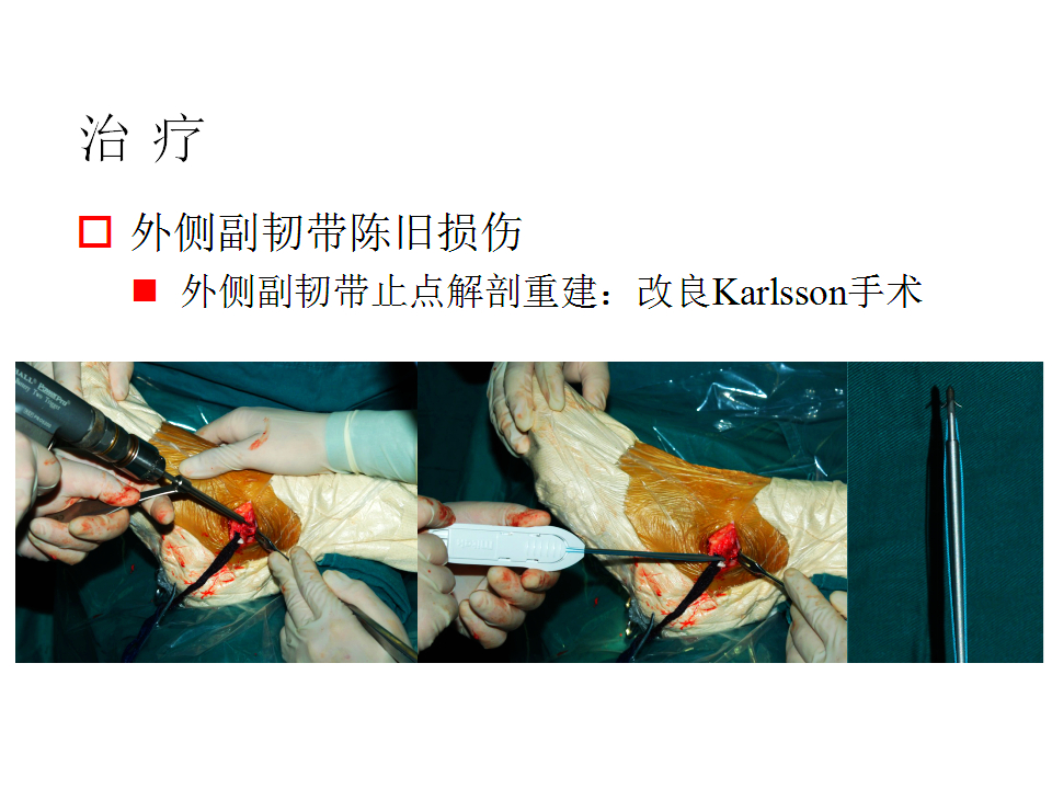 脚崴了怎么办判断是否骨折,脚崴了怎么办视频