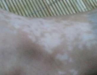 白癜风会遗传下一代吗怎样预防,白癜风好了以后怎么预防复发