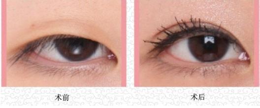 韩式三点双眼皮怎么做,做过韩式三点双眼皮能改成全切吗