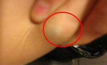 脂肪瘤怎么办教你一招解决,脂肪瘤要注意些什么自己会消失