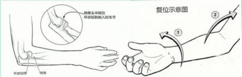 一岁半的宝宝肘关节脱位了怎么办,宝宝肘关节半脱位会影响今后吗