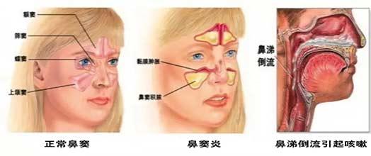 鼻炎鼻窦炎怎么治最有效的方法,鼻炎的7大分类