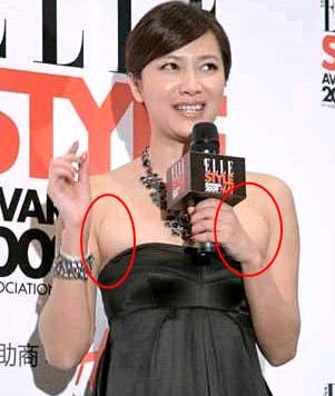 腋窝下有淋巴结会引起乳腺癌吗,腋下淋巴结会是乳腺癌吗