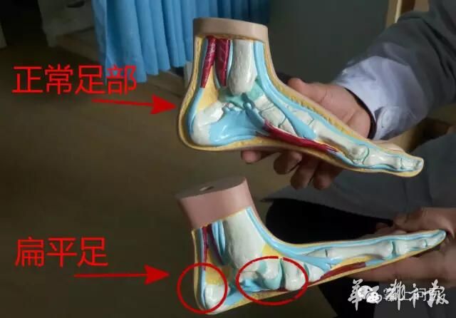扁平足鞋底外侧磨损,低足弓鞋底磨损
