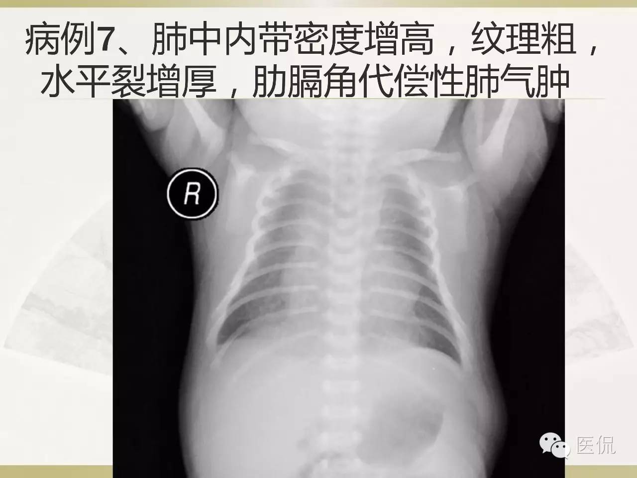 「资料丨医看分享」南边老师肺部群：新生儿透明膜病（HMD）医学影像