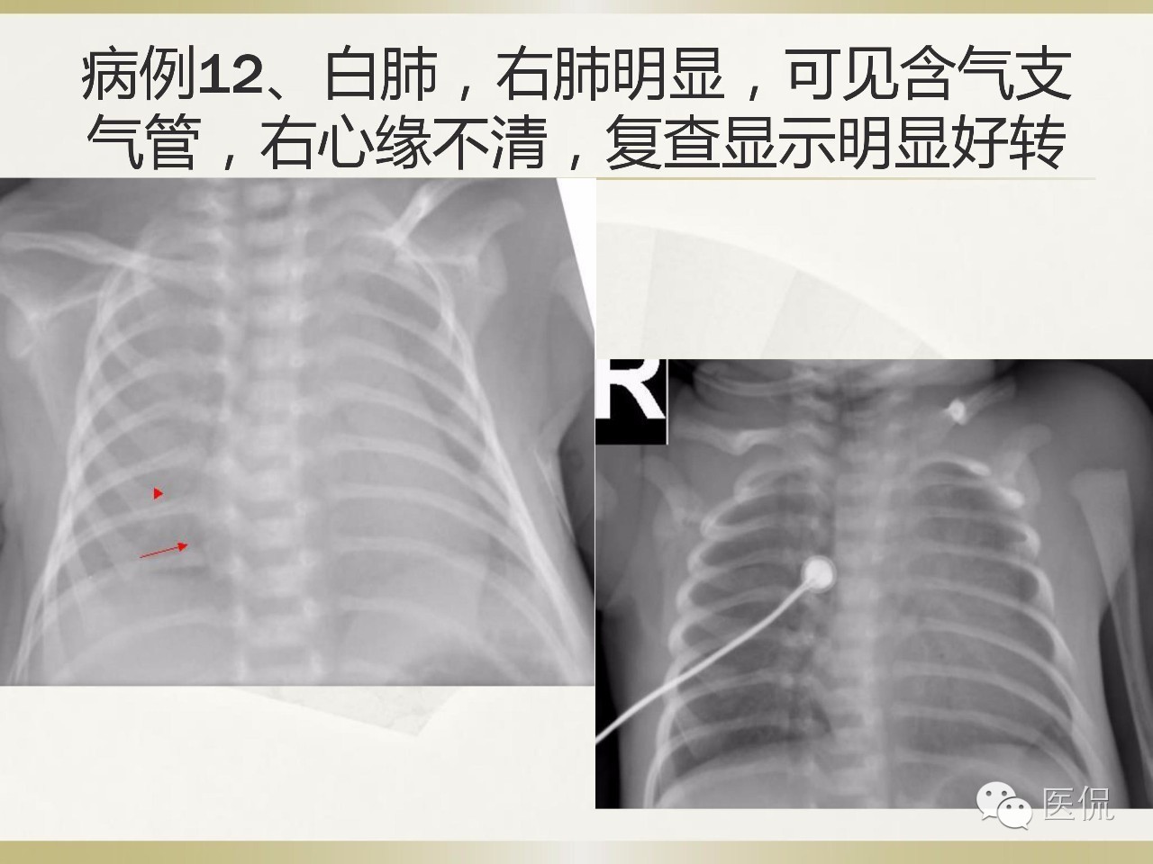 「资料丨医看分享」南边老师肺部群：新生儿透明膜病（HMD）医学影像