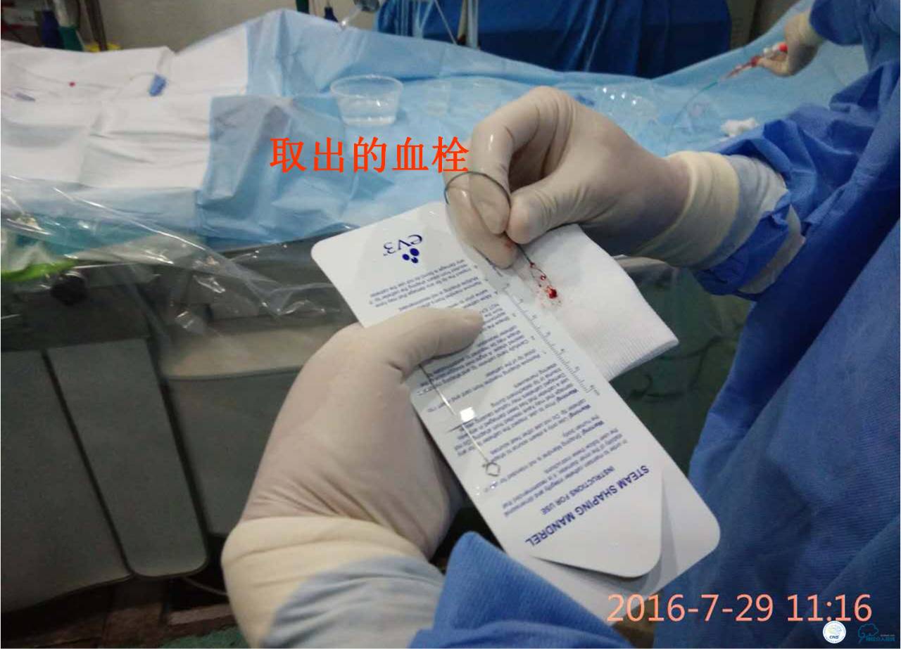 中医治疗基底动脉闭塞,基底动脉尖综合征病例分享