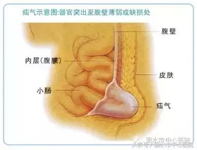 小儿外科疝气健康宣教,门诊实录小儿疝气