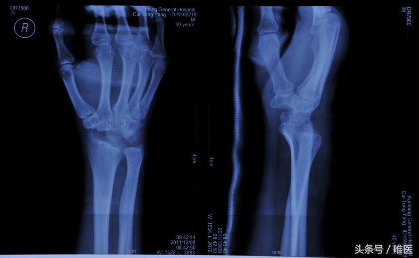 月骨舟骨半脱位手术,手腕舟骨月骨周围脱位要多久康复