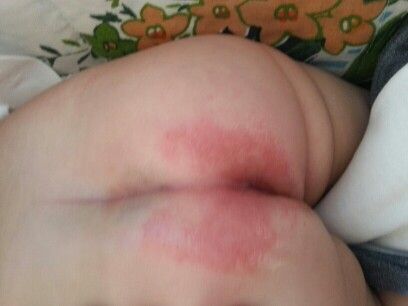 宝宝高烧打寒颤嘴唇紫了怎么办,宝宝高烧腿上有皮下出血