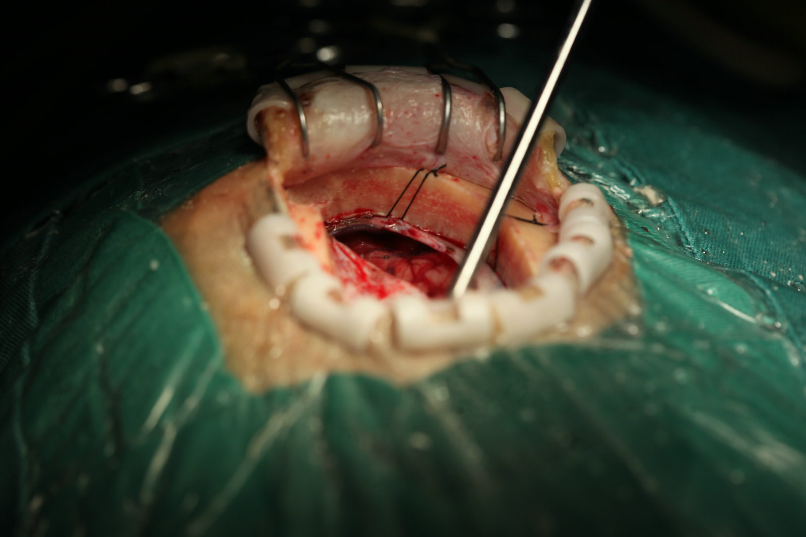 神经外科纪实视频,显微神经外科手术费用