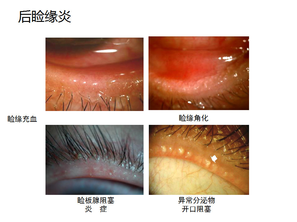 眼睑缘炎的发病原因,眼睑炎的症状和治疗方法
