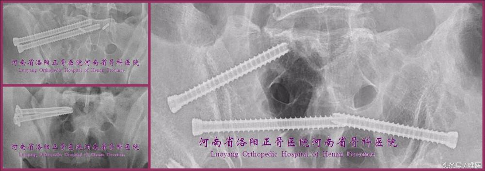 骶髂关节螺钉植入,骶髂关节螺钉手术技巧