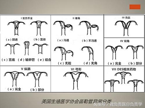 单角子宫合并残角子宫怎么确诊,单角子宫和残角子宫超声报告