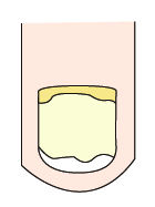 指甲出现白点与竖纹是怎么回事,指甲出现白点什么原因