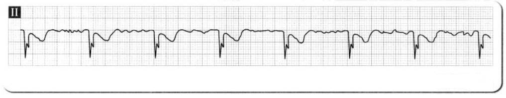 服用什么药物心电图就会正常,服药后做心电图