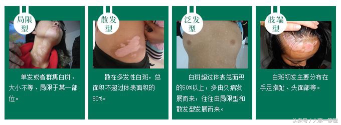 肖海靖点评:白癜风三大伴发疾病你知道多少?