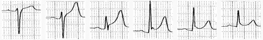 心电图st段抬高0.05mv是什么意思,心电图st段抬高但心脏彩超都正常