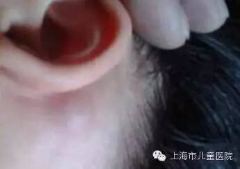 孩子高烧不退当心川崎病,孩子高烧不退当心得了川崎病