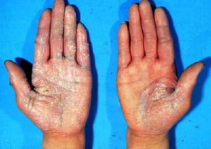 长期保湿有助于牛皮癣的恢复吗,有关牛皮癣常识的详细介绍