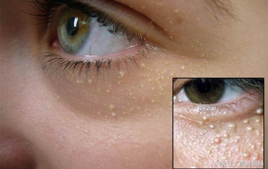 脂肪粒是什么?脂肪粒怎么去掉?它会不会自己消失?