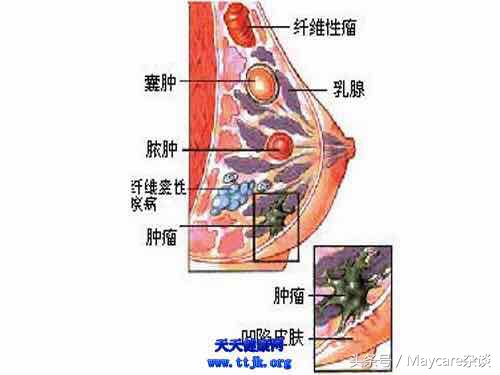 乳腺结节不治是什么结果,猫咪乳腺增生不治会怎么样