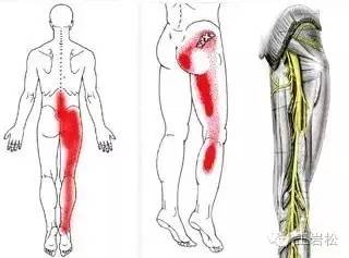 “钥匙孔”解决腰腿痛,骨科治疗新技术(内含术中图片)
