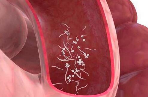 幼儿园蛲虫病检查,幼儿园小女孩蛲虫病