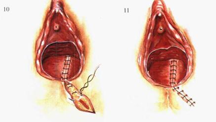 顺产超疼,顺产真疼