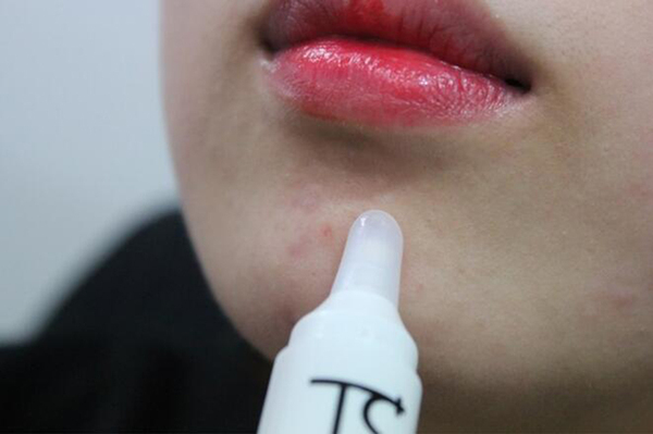 右脸长痘痘是什么原因_怎样快速消除痘痘