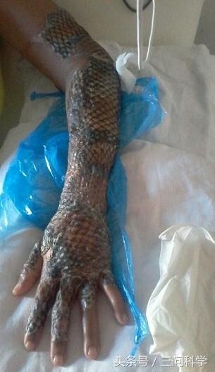 烫伤了不痛,鱼皮治疗烫伤疤痕可以吗