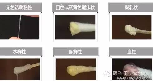 孕期白带哪些异常会导致宫内感染,孕期白带异常有什么影响