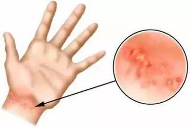 疥疮有什么更好的方法可以拯救,疥疮治愈的小妙招