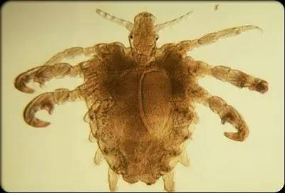 疥疮有什么更好的方法可以拯救,疥疮治愈的小妙招