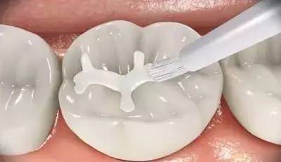 乳牙蛀了要处理吗,不用换的乳牙蛀了怎么办