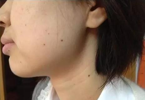 点痣会不会黑色素扩散越来越多,点痣会引起恶性肿瘤吗
