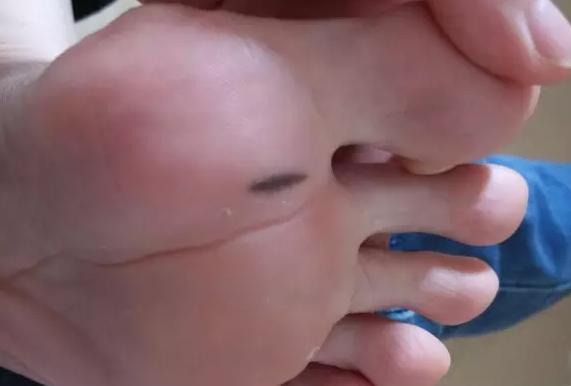 点痣会不会黑色素扩散越来越多,点痣会引起恶性肿瘤吗