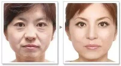 有泪沟怎么办最有效方法,有泪沟怎么办