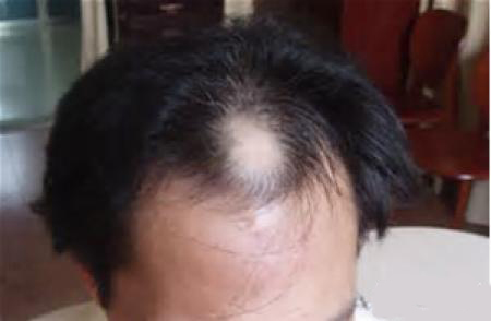 头部脂溢性皮炎,头油,头痒,头屑多,中医用1种针具扣刺