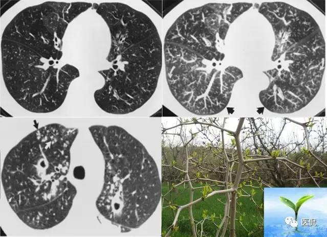 影像学呼吸系统理论知识,呼吸系统疾病影像学常见征象